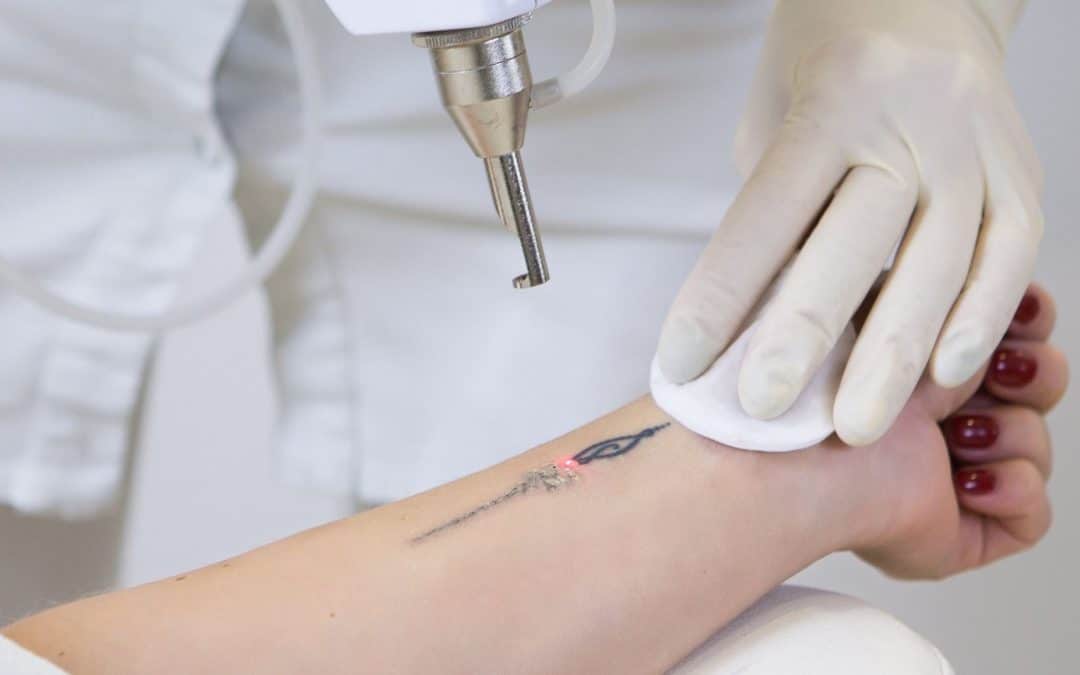 Tips for Better Recovery from Laser Tattoo Removal